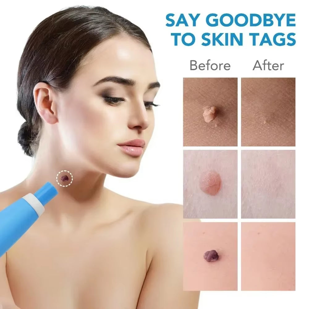 2-in-1 Painless Skin Tag & Wart Removal Kit - Effective Face & Body Treatment Tools for Flawless Skin